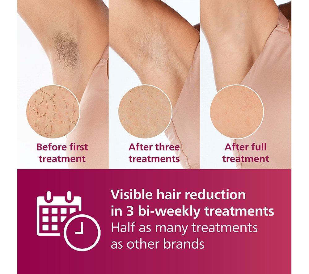 PHILIPS Lumea 7000 Series BRI923/00 IPL Hair Removal System with Pen Trimmer - White image number 3 of 10