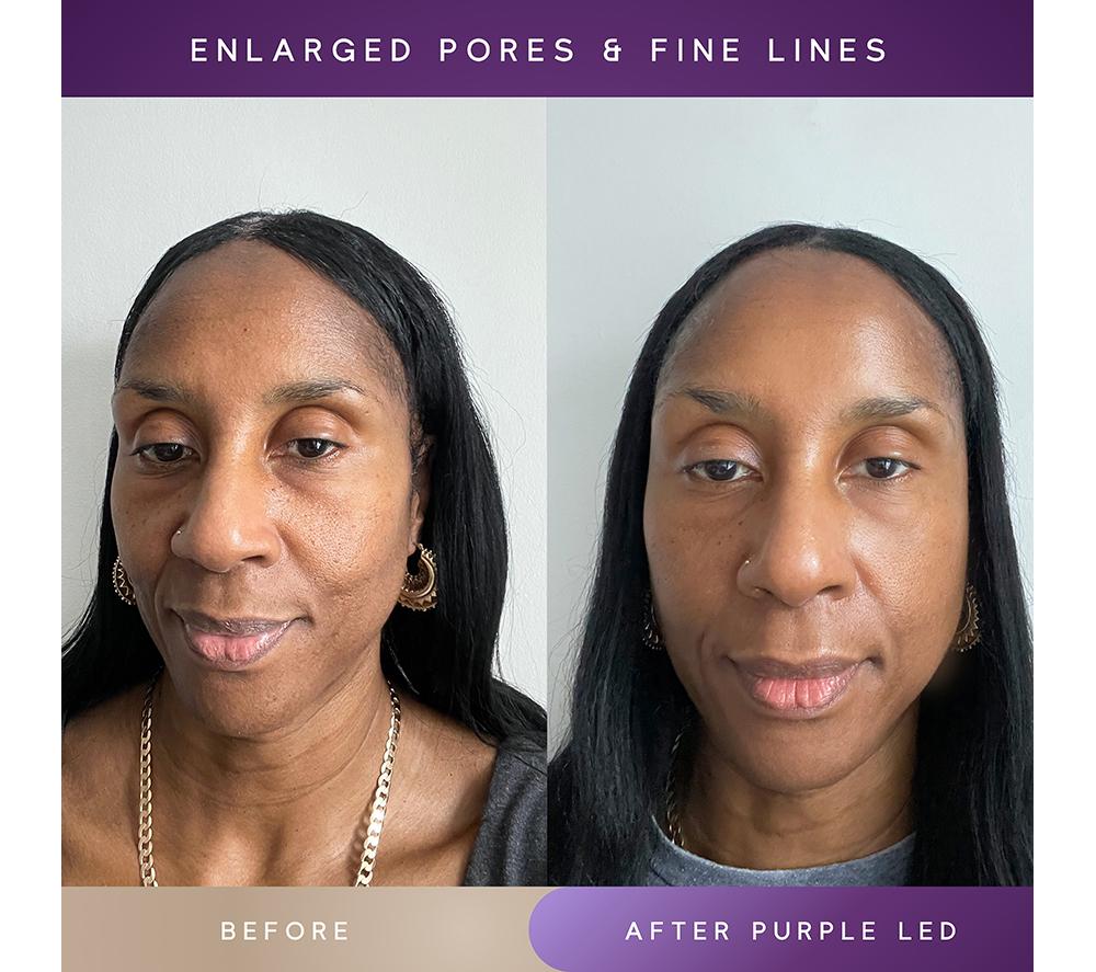 SENSSE SNSE30 Elite LED Face Mask - Nude image number 15 of 18