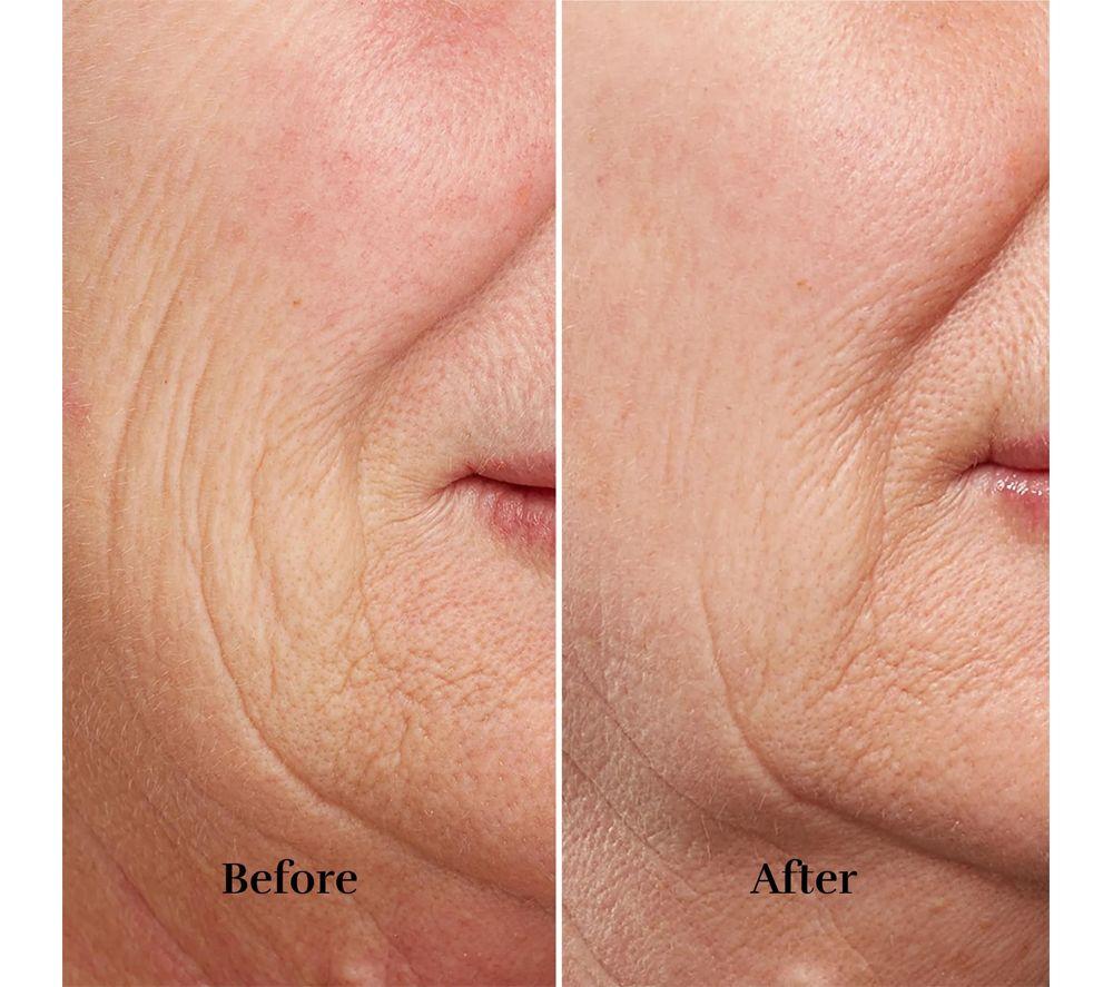 SILK'N FaceTite Revive Facial Rejuvenator image number 7 of 8