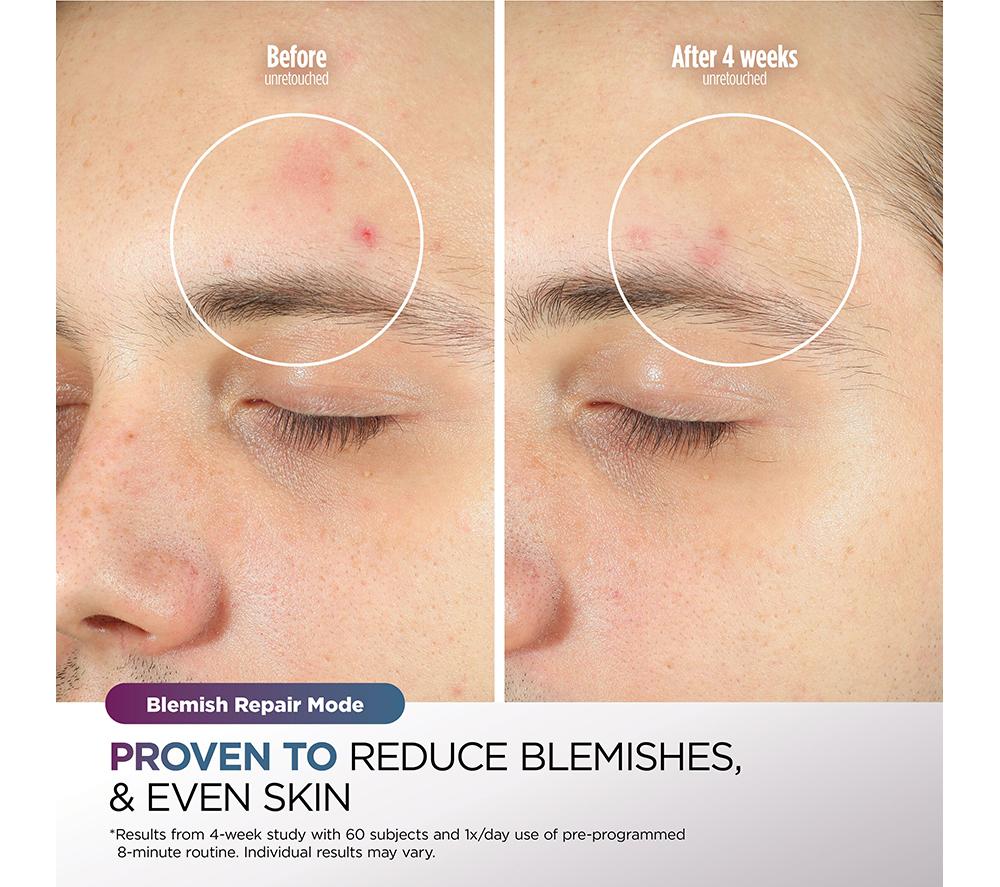 SHARK FW312IEPL CryoGlow Under-Eye Cooling LED Anti-Ageing & Blemish Repair Mask &ndash; Lilac Chill image number 7 of 12